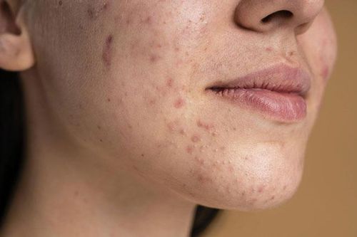 Bí quyết trị vết thâm do mụn cực nhanh và hiệu quả