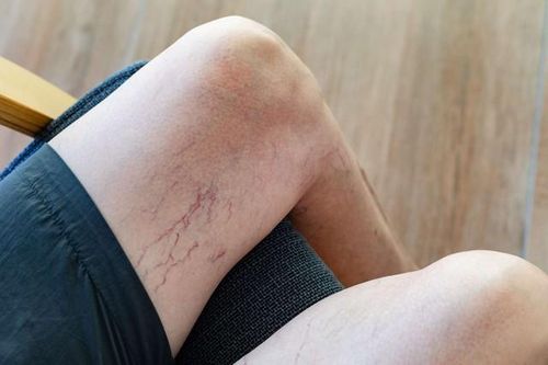 Suy giãn tĩnh mạch chi dưới dễ chẩn đoán nhầm với bệnh nào?