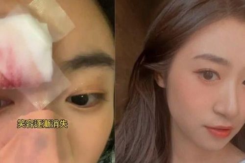 Diễn viên xinh đẹp đột ngột ngất xỉu, đập mặt xuống đường, rách mũi và cằm