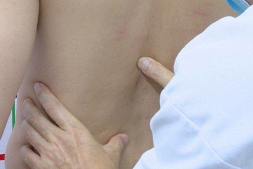 Nam thanh niên bị gãy xương sườn sau khi đi bẻ khớp tại nhà thầy lang