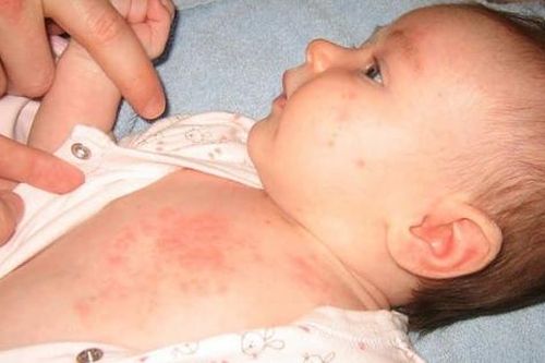 Viêm da mủ ở trẻ sơ sinh mùa nóng
