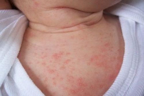 Nguyên nhân khiến trẻ thường bị rôm sảy vào mùa Hè