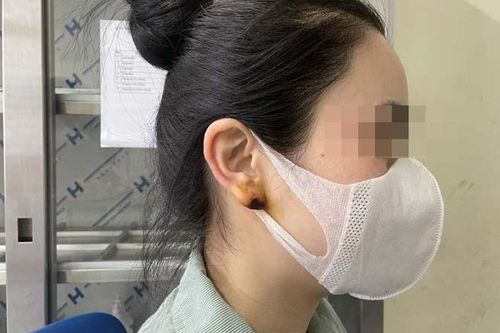 Tiêm filler tai Phật để 'thay đổi vận mệnh', cô gái trẻ phải nhập viện cấp cứu
