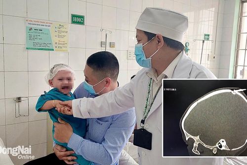 Bé trai bị cây đinh dài khoảng 3cm đâm qua xương sọ