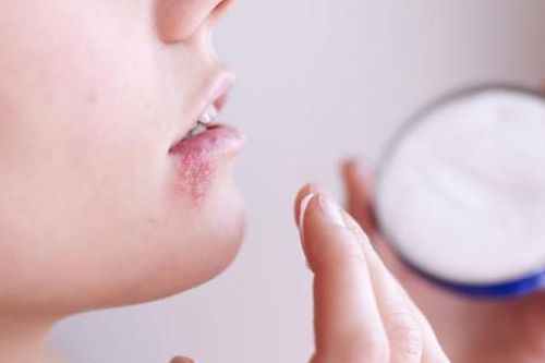 Điều trị viêm da do Herpes như thế nào?