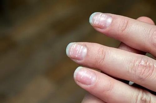 Vệt trắng trên móng tay cảnh báo vấn đề sức khỏe gì?