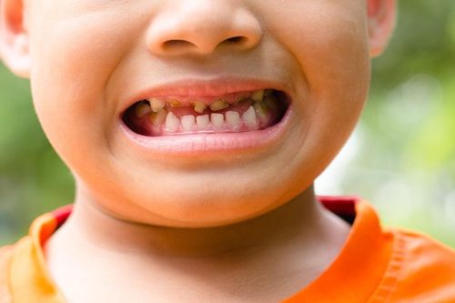Những trẻ có nguy cơ bị sâu răng