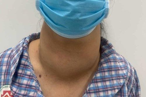 Đi khám vì nuốt vướng, người phụ nữ phát hiện khối u khổng lồ