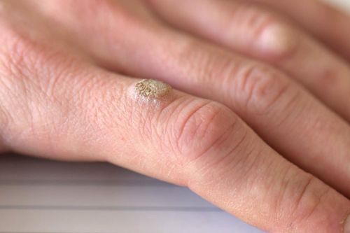 Mụn cóc có thể lây lan?