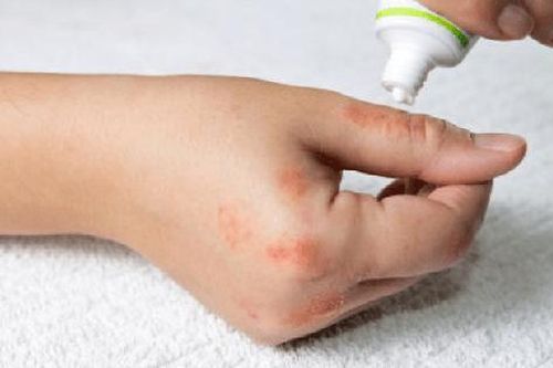 Điều trị viêm da tiếp xúc do kiến ba khoang
