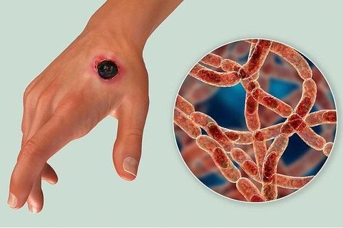Bệnh than gây loạt biến chứng nguy hiểm...phòng tránh thế nào?