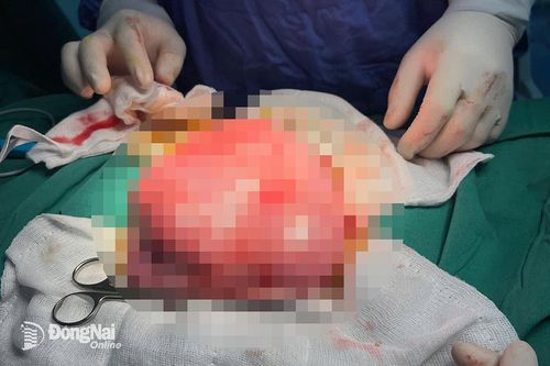 Phẫu thuật lấy khối u xơ tử cung to như trái bóng đá, nặng gần 3kg