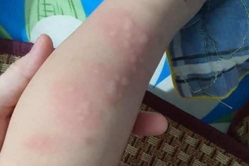 Mẹ run rẩy phát hiện con 15 tháng tuổi nhiễm giun đũa chó và giun lươn