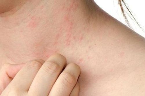 Viêm da dị ứng: Điều trị thế nào cho hiệu quả?