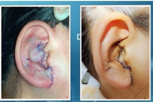 Bé gái bị đứt gần toàn bộ tai do tai nạn giao thông