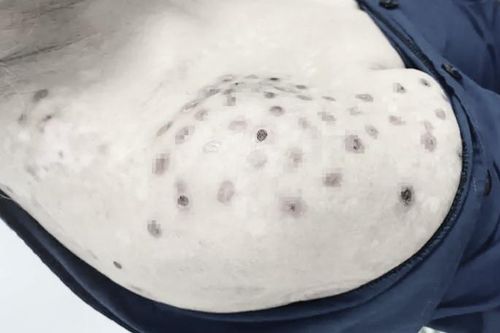 Bỏng da sau khi đốt ngải, hương, chữa mỏi vai gáy