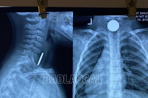 Cấp cứu thành công trẻ 4 tuổi hóc đồng xu