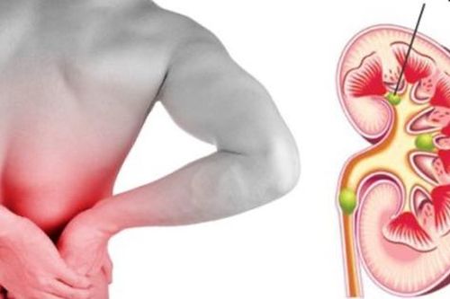 3 lưu ý phòng sỏi thận tái phát trong mùa hè