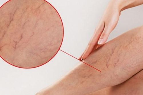 Ứng phó với suy giãn tĩnh mạch bằng các biện pháp tại nhà