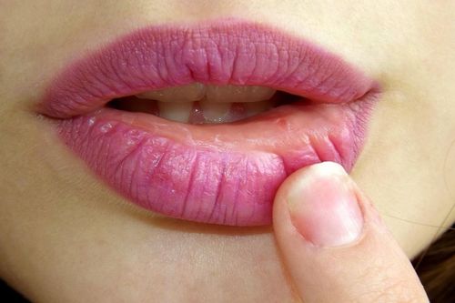 Nhập viện vì kích ứng sau khi dùng son giá rẻ
