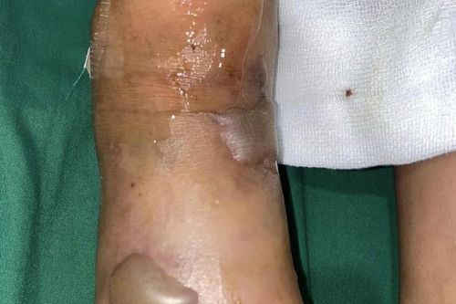 Cảnh báo nguy cơ rắn độc cắn mùa mưa