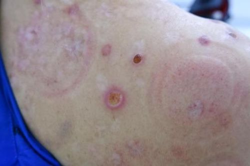 Bỏng da vì đốt ngải, đốt hương trị đau cổ vai gáy