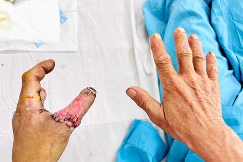 'Cái hóa' thành công cho bệnh nhân đứt lìa ngón tay