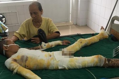 Mẹ khóc ngất cầu cứu vì con trai bị điện giật bỏng nặng không tiền cứu chữa