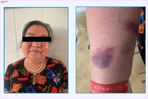 Dùng thuốc giảm đau không rõ nguồn gốc, người phụ nữ nhập viện cấp cứu