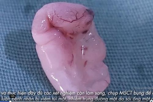 Cận cảnh bắt sán lá gan đang ngoe nguẩy trong bụng người đàn ông