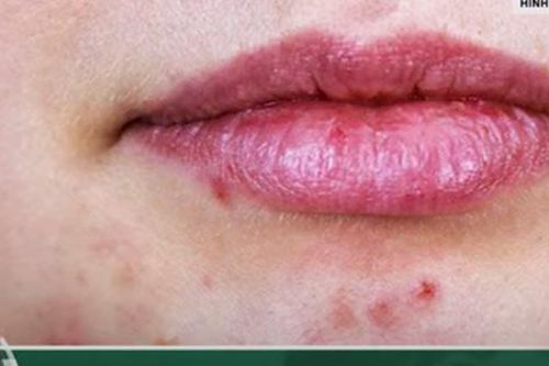 'Bắt bệnh' từ vị trí mọc mụn