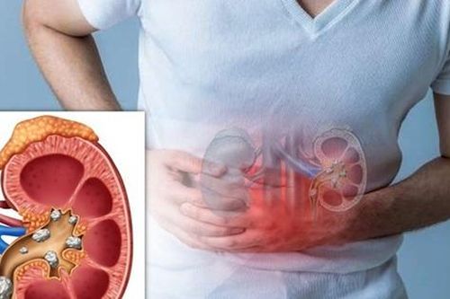 Mắc sỏi thận, nhất định bạn phải biết những điều sau đây