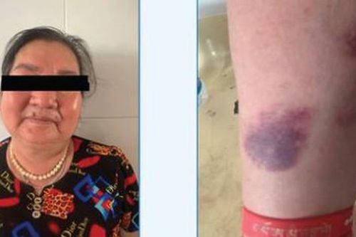 Tự chữa đau xương khớp, cụ bà suy tuyến thượng thận