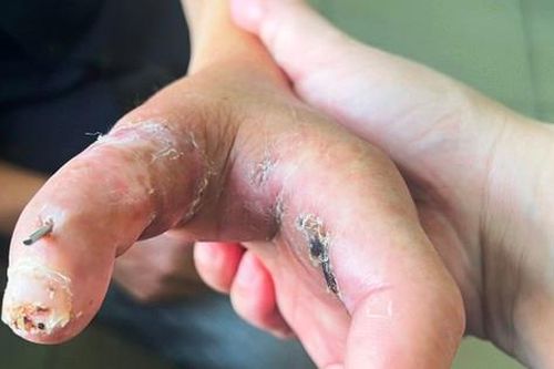Mang ngón tay đứt lìa vào bệnh viện được các bác sĩ nối lại thành công