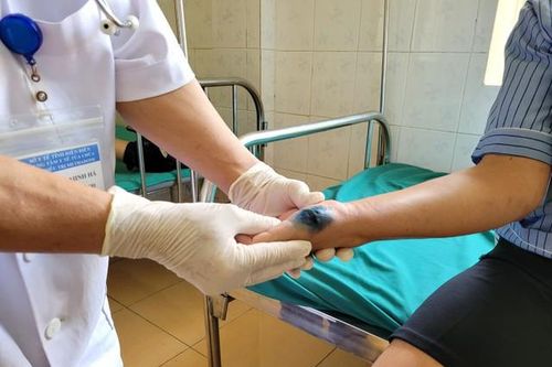 Điện Biên thông tin trường hợp trẻ nhỏ nghi mắc bệnh than