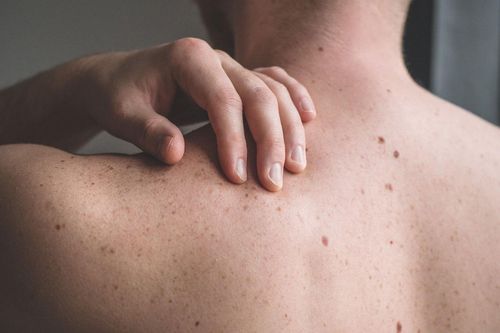Những lầm tưởng về ung thư da