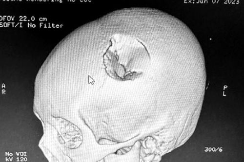 Bệnh nhi 12 tuổi ngã từ trên cao xuống bị vỡ lún xương sọ
