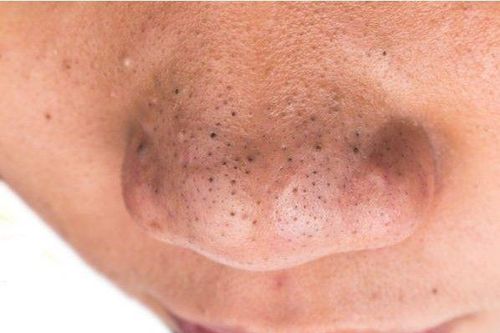 Loại bỏ mụn đầu đen ở mũi hiệu quả tại nhà