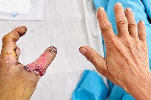 Nối thành công ngón tay bị đứt lìa do tai nạn lao động