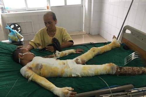 MS 851: Mẹ bầu 3 tháng khóc ngất cầu xin mọi người cứu con trai bỏng nặng vì điện giật