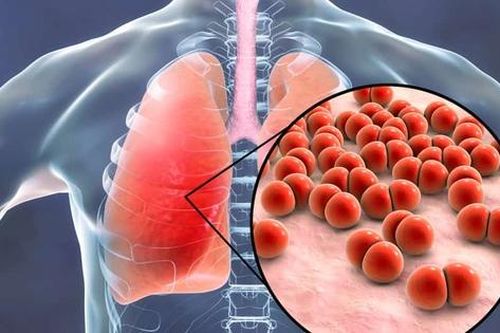 Dấu hiệu cho biết bạn đã mắc viêm phổi và cách xử trí