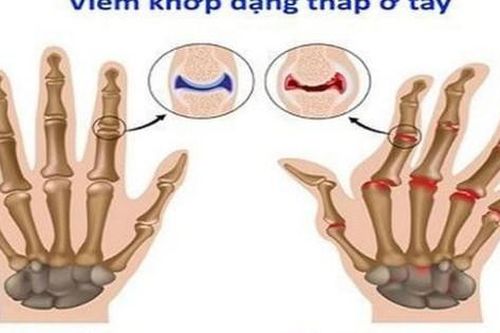 Bài thuốc điều trị viêm khớp dạng thấp