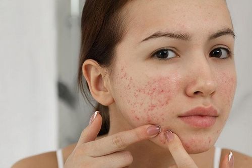 Nguyên nhân khiến da mụn mãi không khỏi