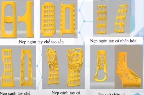 Nẹp chấn thương chỉnh hình bằng công nghệ in 3D