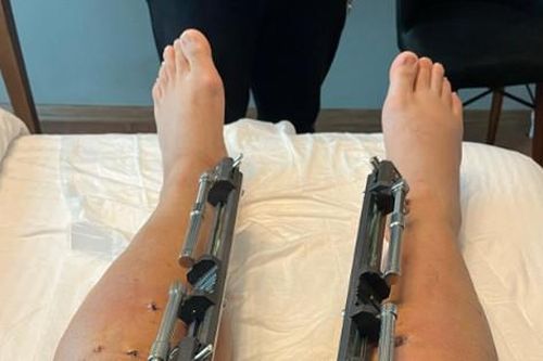 Người đàn ông cao 1,8m vẫn phẫu thuật kéo dài chân vì một lý do