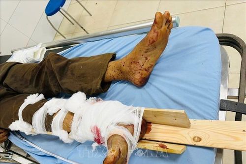 Nối thành công cẳng chân đứt rời cho nam bệnh nhân bị tai nạn lao động