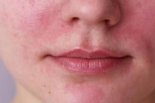 Các vấn đề về da và tóc phổ biến mà phụ nữ phải đối mặt