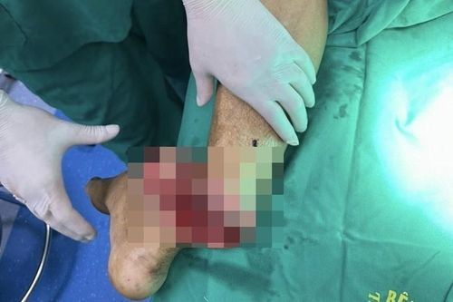 Người đàn ông nhập viện với cẳng chân đứt lìa sau tai nạn