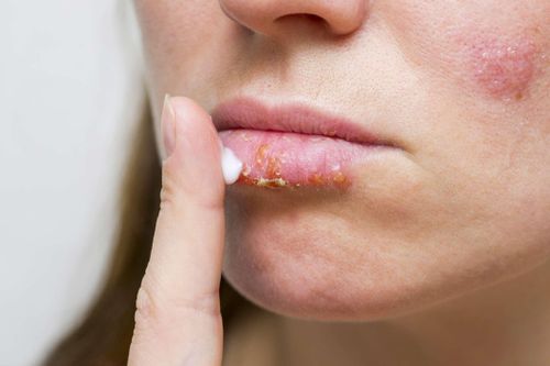 Triệu chứng nhận biết môi bị cháy nắng