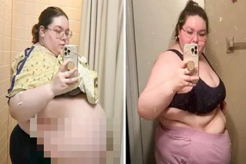 Tưởng béo phì, cô gái trẻ lặng người phát hiện khối u 'khủng'